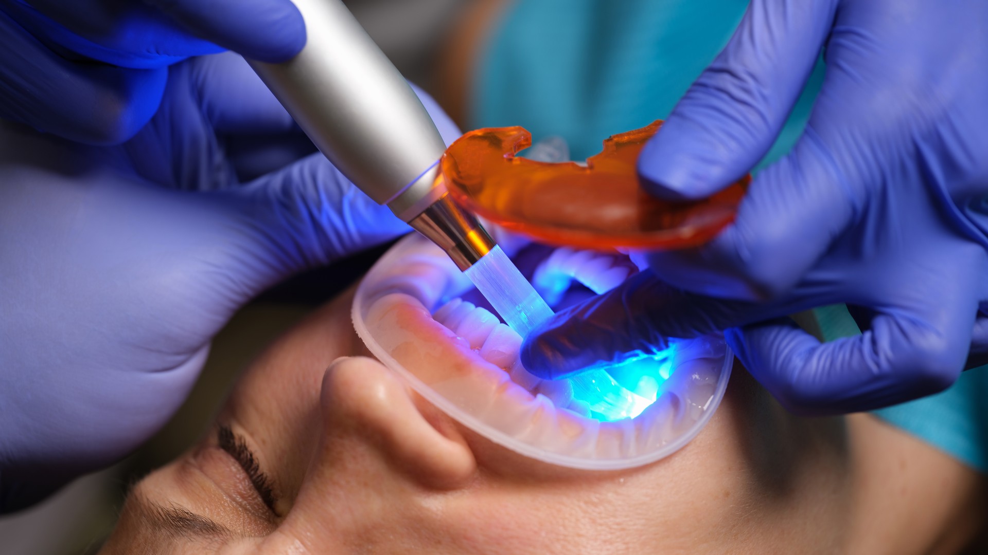 Restoration of teeth with filling-polymerization lamp